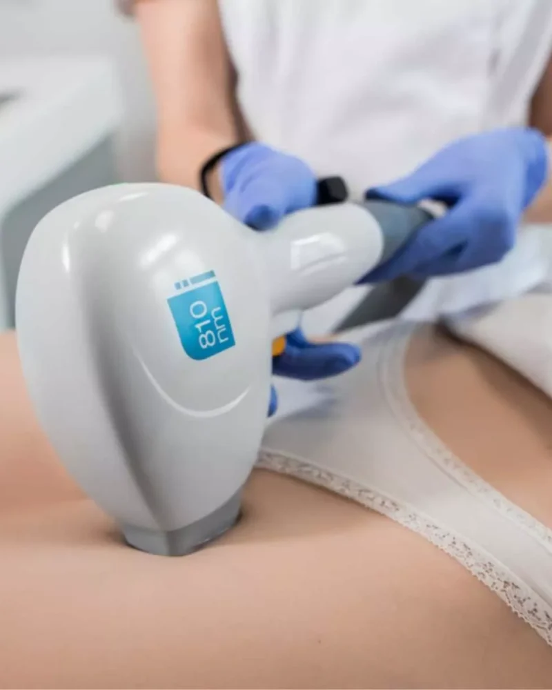 Depilacja laserowa — laser diodowy 810 nm